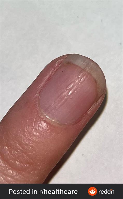 Nail ridges : r/DermatologyQuestions