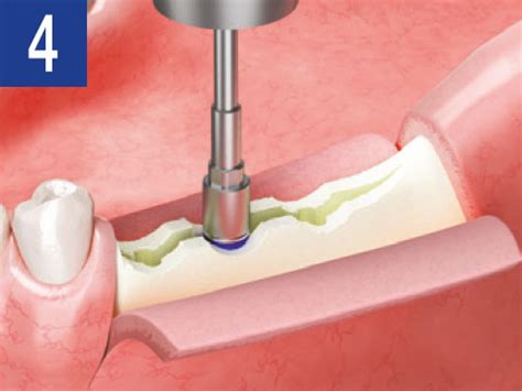 Osstem Implant