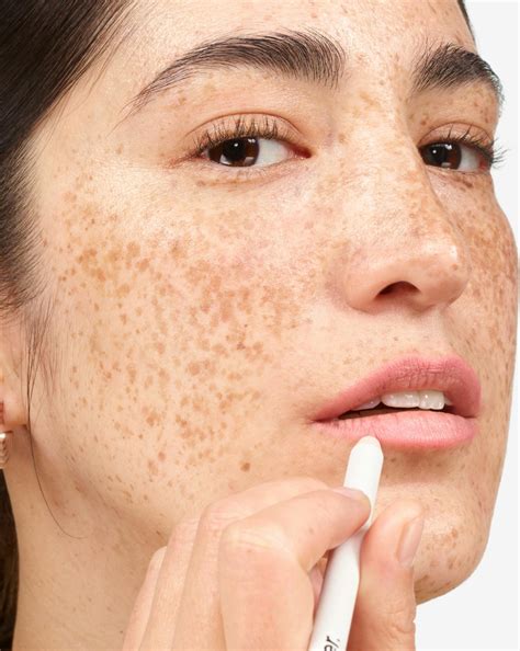 blackheads along lip line 4