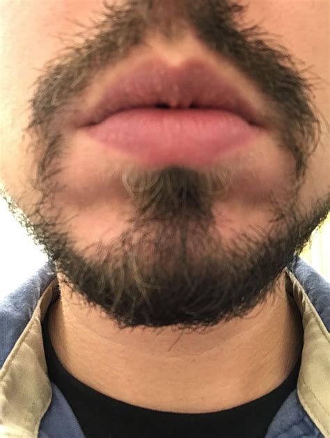 New Treatment Method : r/exfoliativecheilitis