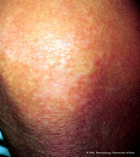 Dermatomyositis Rash Images