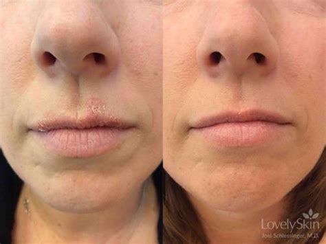 Hydrocortisone cream for face - raserthinking
