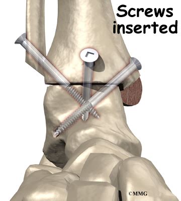 Ankle Fusion - eOrthopod.com