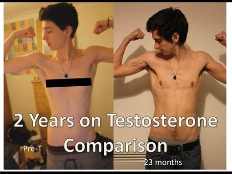Ftm Before And After Testosterone