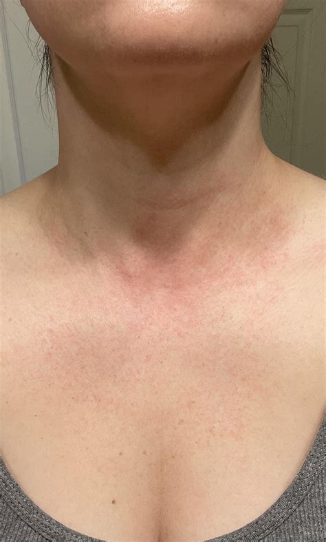Lupus rash?? : r/lupus