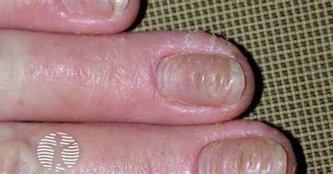 complications  pompholyx image