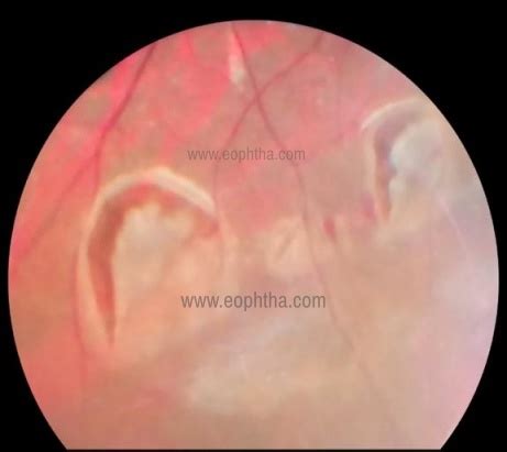 Peripheral Retinal Degenerations: A Ready Reckoner