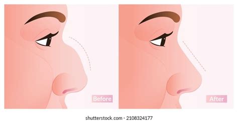 Female Nose Before After Plastic Surgery Stock Vector (Royalty Free ...