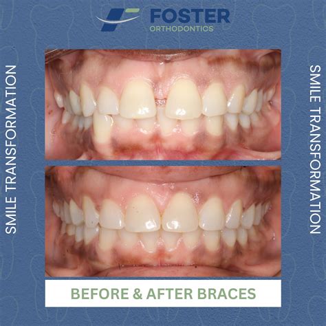 Before & After | Foster Orthodontics