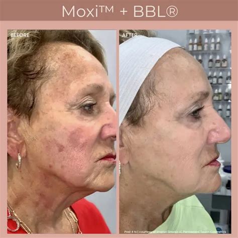 levisa lazer: Before & After Photos That Will Amaze You - 8532mn5