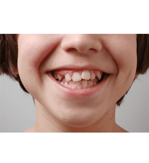 What Is Ankylosis Of Teeth - Causes, Treatment, And All