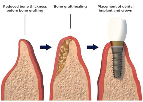 bone graft  dental implant  explained   dentist