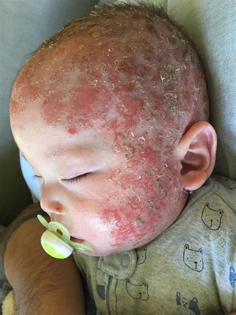 Toddler left screaming in agony with red raw, oozing skin after eczema