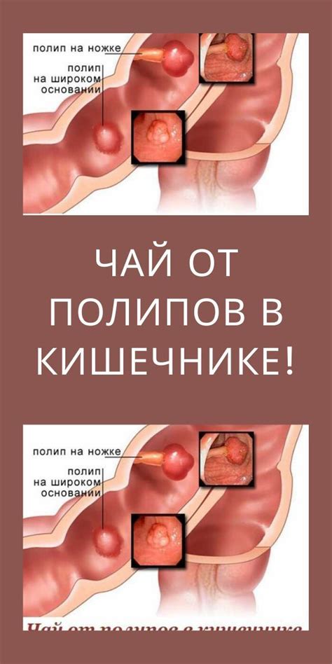 Чай от полипов в кишечнике! в 2024 г | Здоровье кишечника, Товары для ...