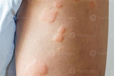 Young asian man has allergic skin rash on his legs from itchy dry skin