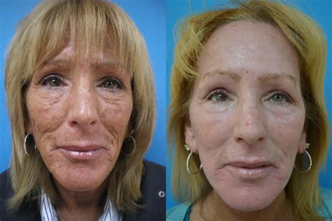 laser skin resurfacing   gallery