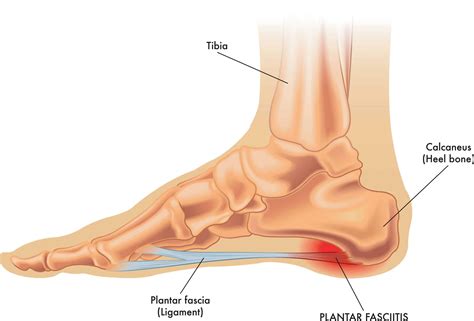 Posterior Tibial Tendonitis: Differential Disgnosis