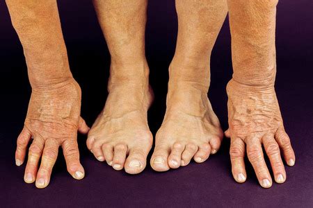 8 Tips to Heal Your Arthritic Foot Pain — North Fork Podiatry | Three Village Podiatry