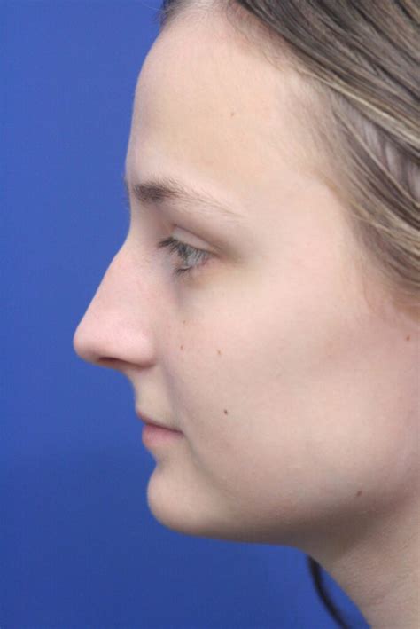 Rhinoplasty | Nose Surgery Near Me