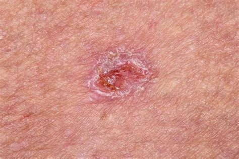 summerland skin cancer clinic basal cell carcinoma vrogue
