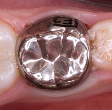 preformed metal crown  primary molars conventional  hall