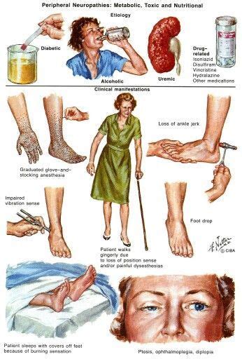 8 Peripheral Neuropathy,Idiopathic Neuropathy ideas | neuropathy ...