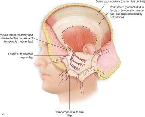 Temporoparietal Vs Temporal 
