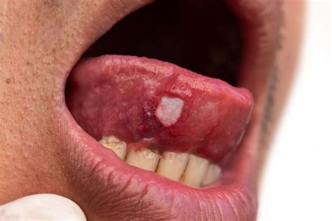 Cancer Embaixo Da Lingua - Tongue Cancer - Dr Nitin Tomar Tongue Cancer