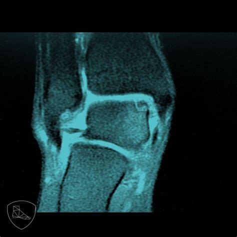 Refresca tus conocimientos sobre la osteocondritis del astrágalo y su