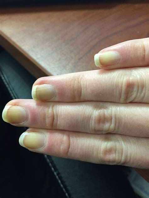 Fingernails un-yellowing : r/stopsmoking