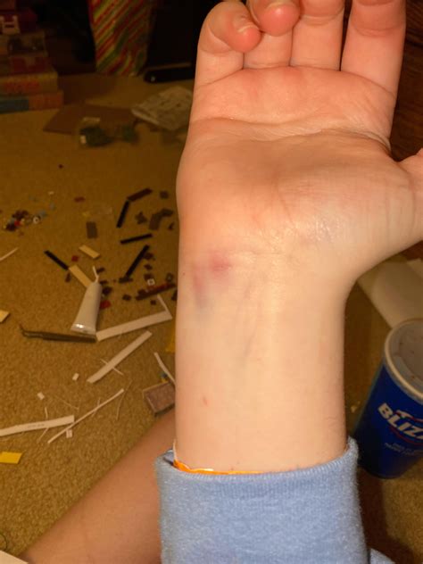 this bruise i got while ice skating : r/ouchies