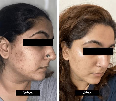 Salicylic Acid Acne Before And After