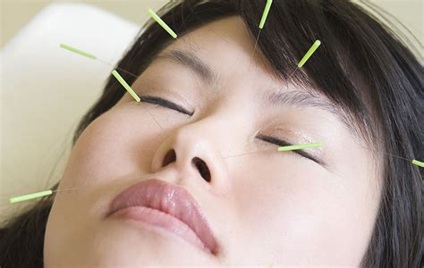 acupuncture   natural face lift