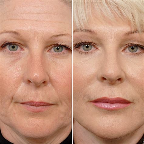 Do Hifu Non-surgical Renovations Truly Work