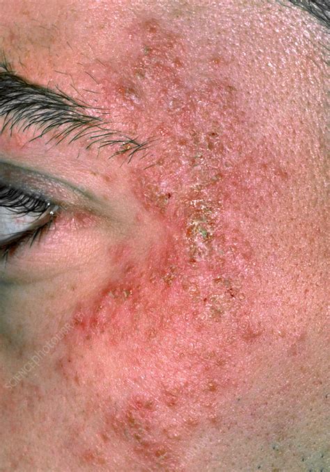 face eczema   peggy hodges blog