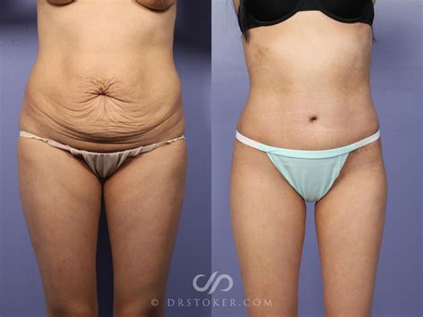 Tummy Tuck Transformation: Before And After Results