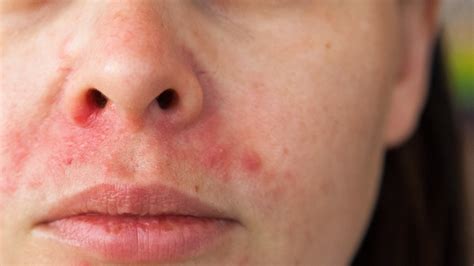 perioral dermatitis  symptoms treatment gladskin