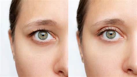 Droopy Eyelid Botox Before And After - Infoupdate.org