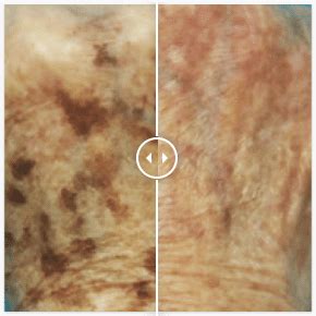 Laser Acroma Antes E Depois - Laser Acroma: O Tratamento Ideal para Melasma e Rejuvenescimento