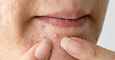 Whiteheads: Causes, Symptoms, And Treatments | Ova SG
