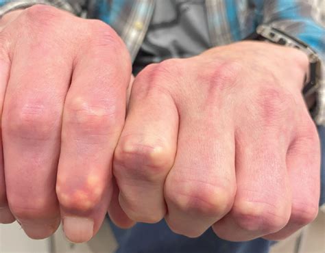 Finger nodules: Tip of the gouty iceberg | Cleveland Clinic Journal of ...