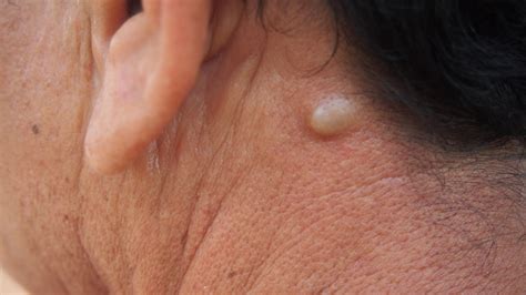 What's a Sebaceous Cyst? Signs, Treatments, and What to Expect – 1MD ...