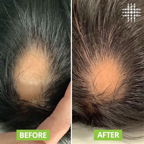 Hair Regrowth Therapy Before and After Results - Results Laser Clinic