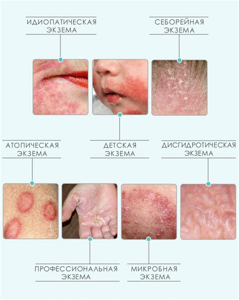 Microbial eczema: patient management algorithm - Estet-Portal