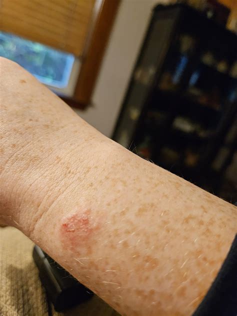 Itching bumps on hands and wrists : r/DermatologyQuestions