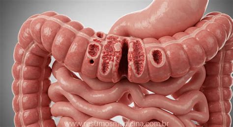Doença De Crohn Tratamento - Doença de Crohn: Guia Completo de Tratamento Cirúrgico, Clínico e ...