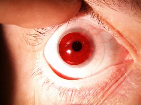 Achromatopsia | Lenses to Improve Day-Time Light Sensitivity | EYETECH