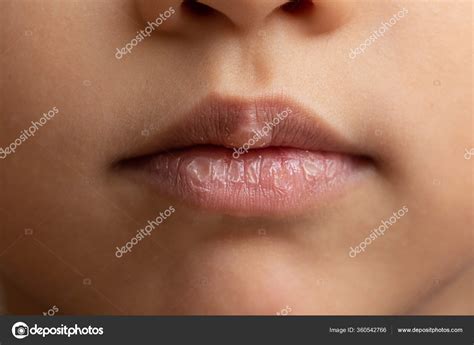 Crusty Lips