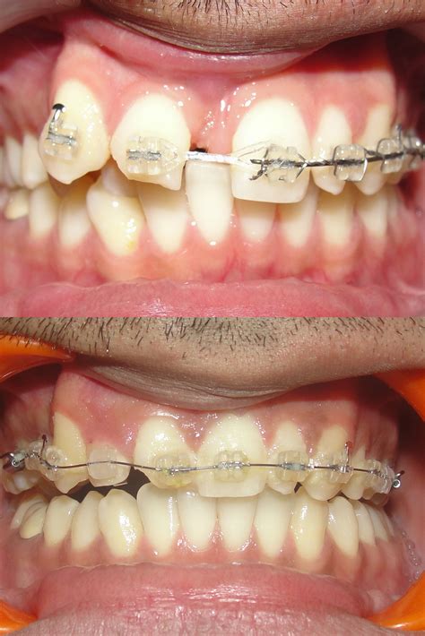 Teeth Removal | Dentagama