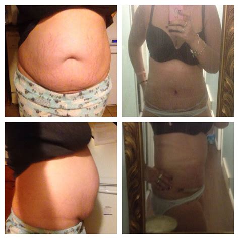 Tummy Tuck With Muscle Repair Before And After - Electrical Panel Repair